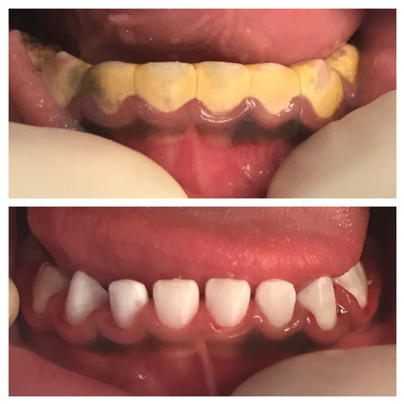gray between front teeth calculus